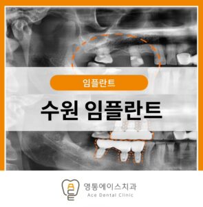 수원 임플란트
