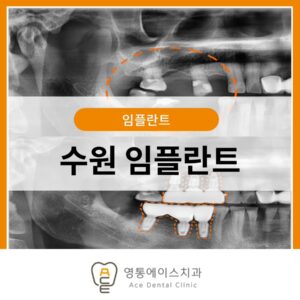 수원 임플란트