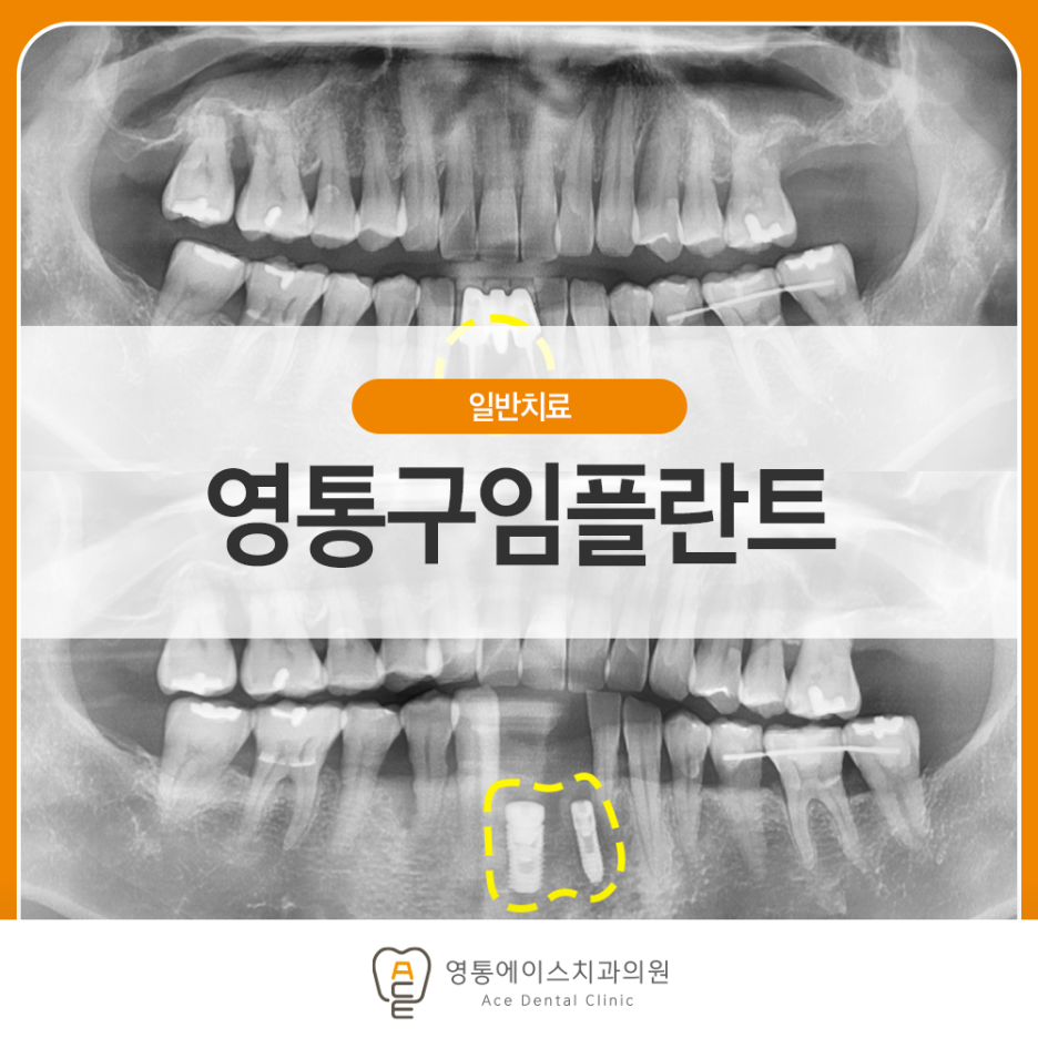 망포역임플란트 