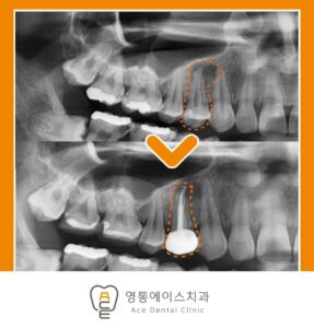 망포 신경치료
