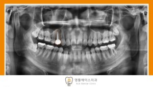 망포 신경치료