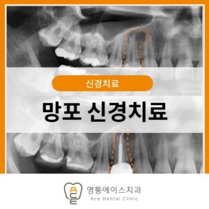 망포 신경치료
