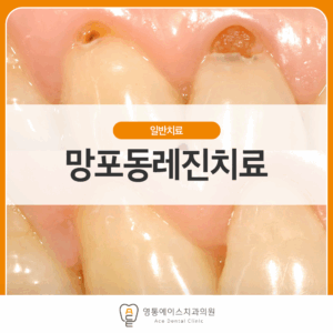 영통에이스치과 레진치료