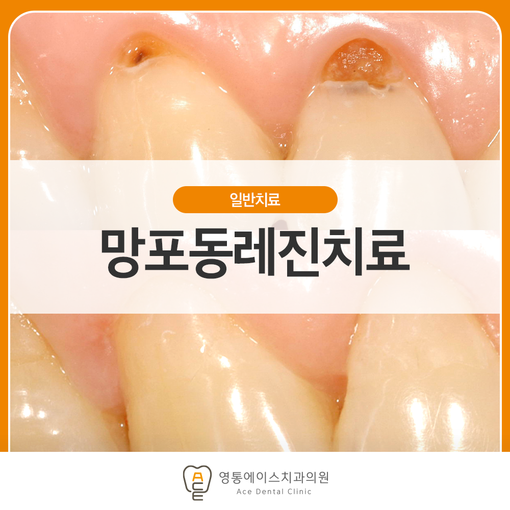 영통에이스치과 레진치료