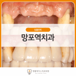 영통에이스치과 임플란트