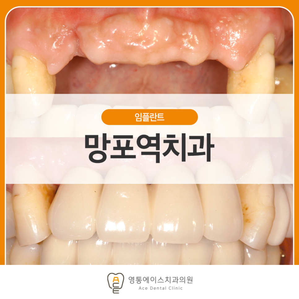 영통에이스치과 임플란트