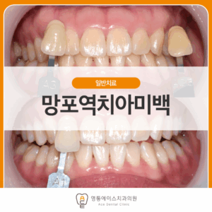 영통에이스치과 치아미백