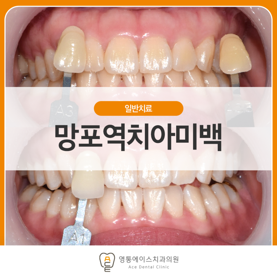 영통에이스치과 치아미백