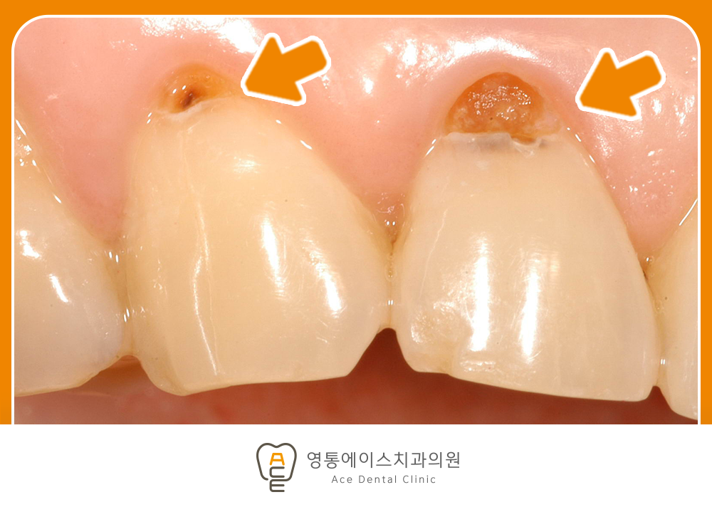 영통에이스치과 레진치료