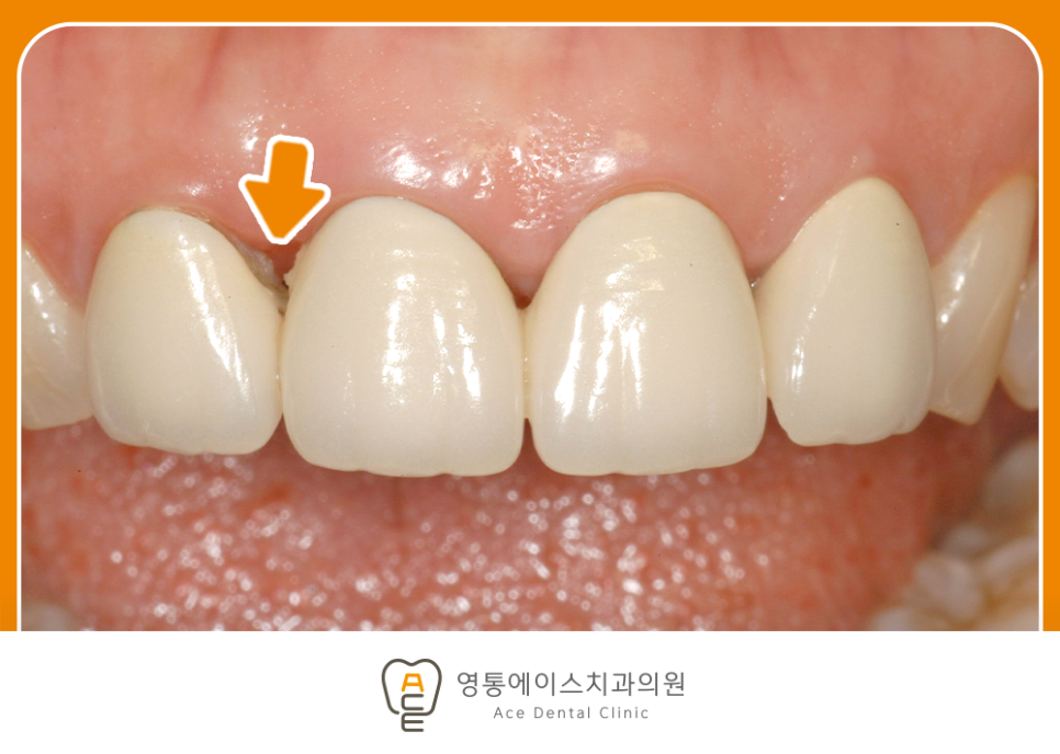 영통에이스치과 심미보철