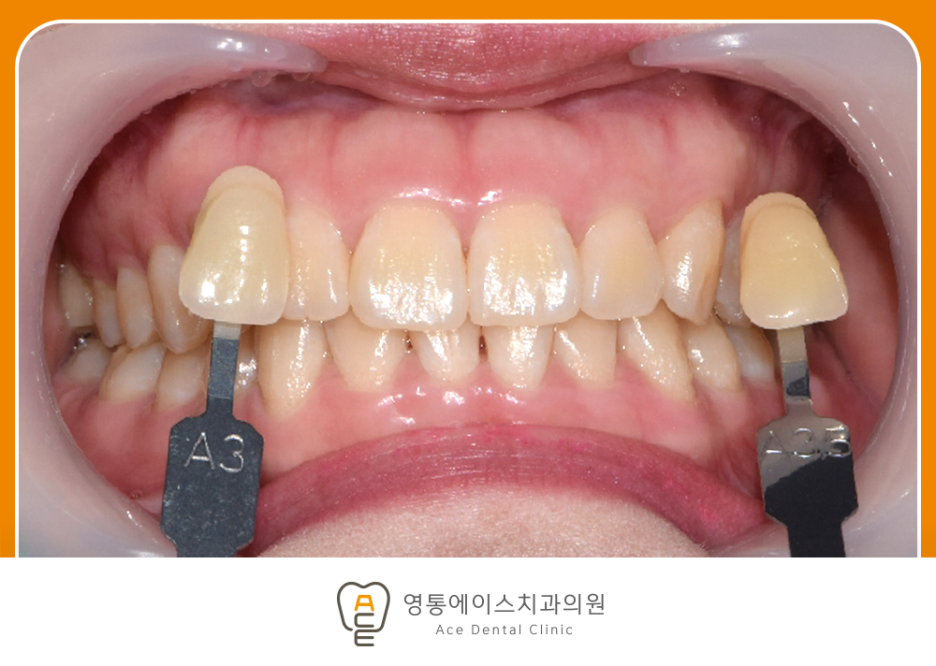 영통에이스치과 치아미백