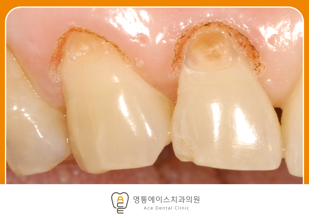 영통에이스치과 레진치료