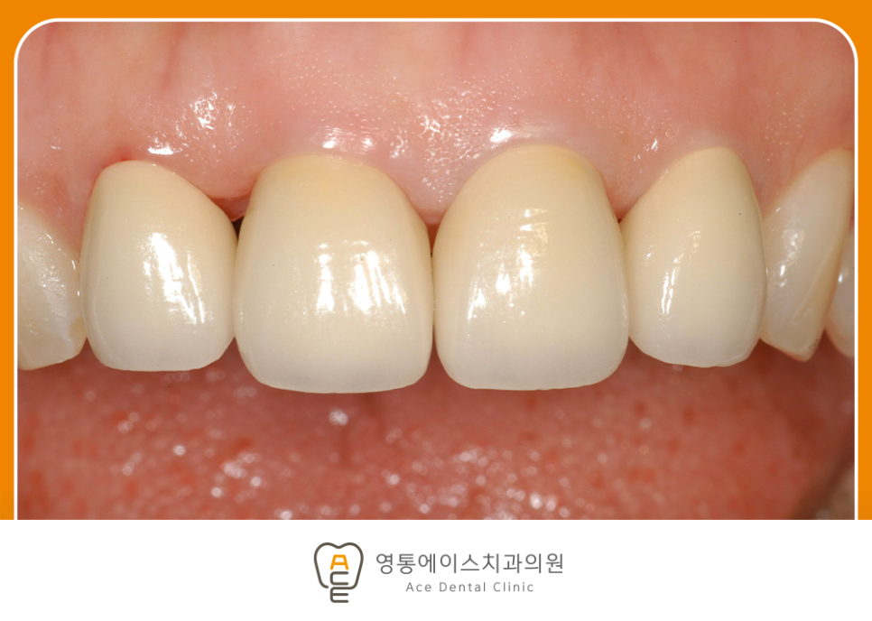 영통에이스치과 심미보철