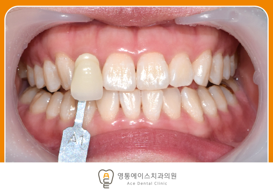 영통에이스치과 치아미백