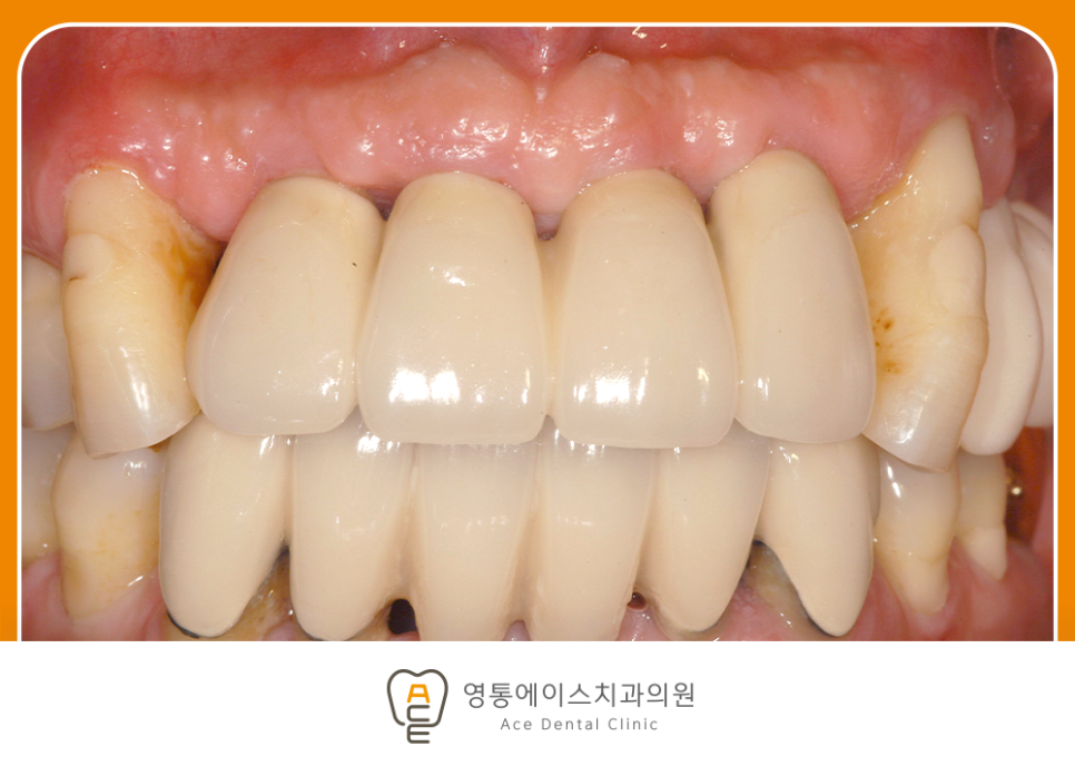 영통에이스치과 임플란트