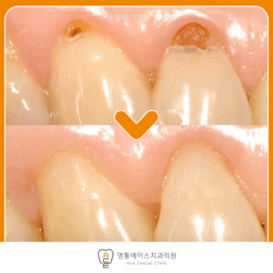 영통에이스치과 레진치료