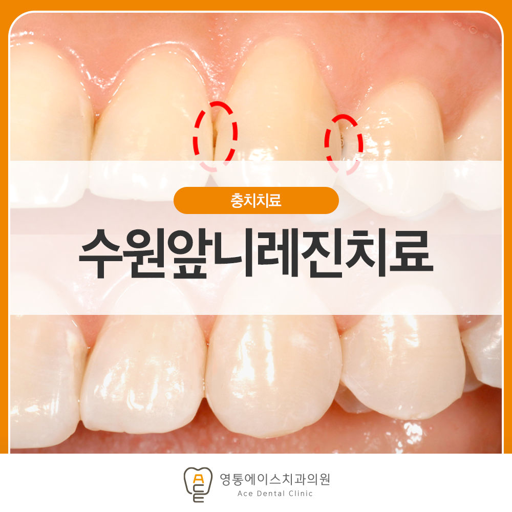 영통에이스치과 레진치료