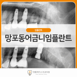 영통에이스치과 임플란트
