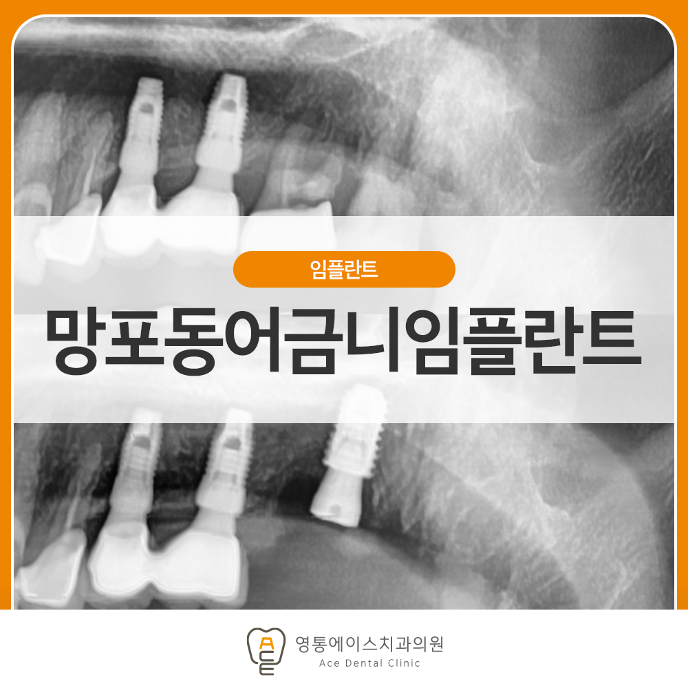 영통에이스치과 임플란트