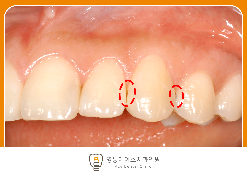 영통에이스치과 레진치료