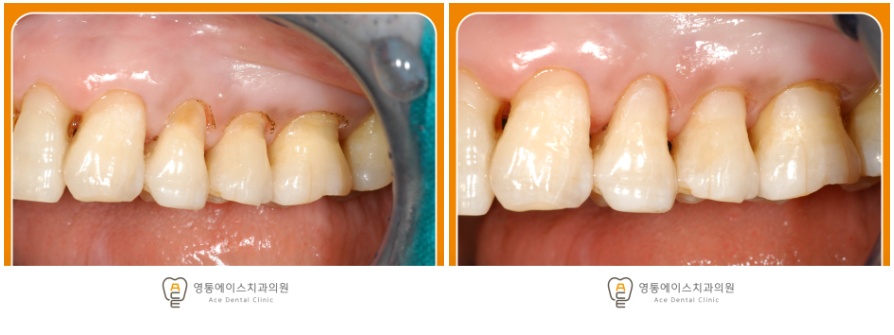 영통에이스치과 레진치료