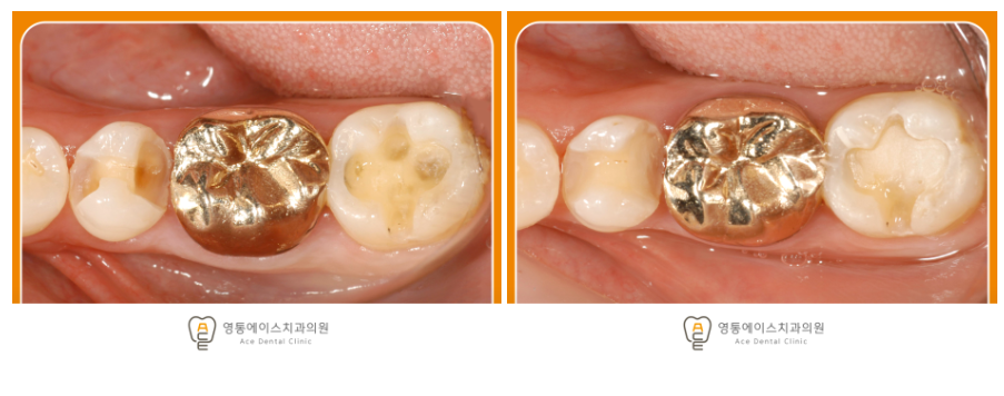 영통에이스치과 충치치료