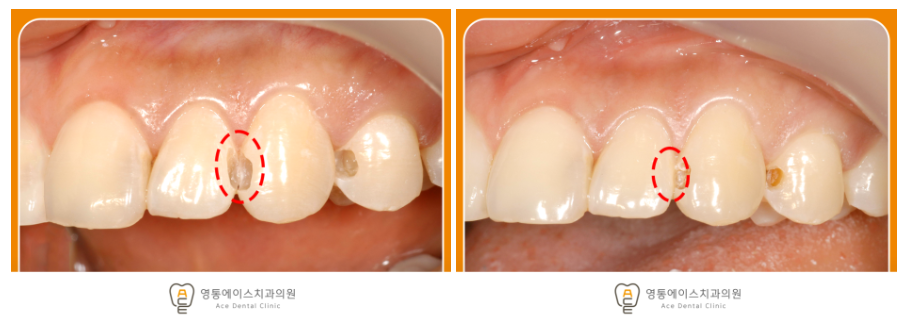 영통에이스치과 레진치료