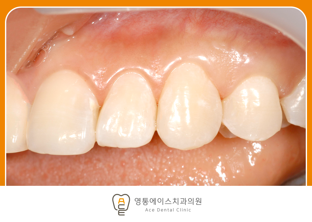 영통에이스치과 레진치료