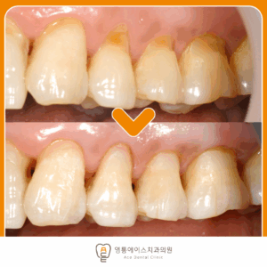 영통에이스치과 레진치료
