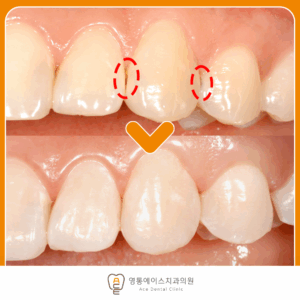 영통에이스치과 레진치료