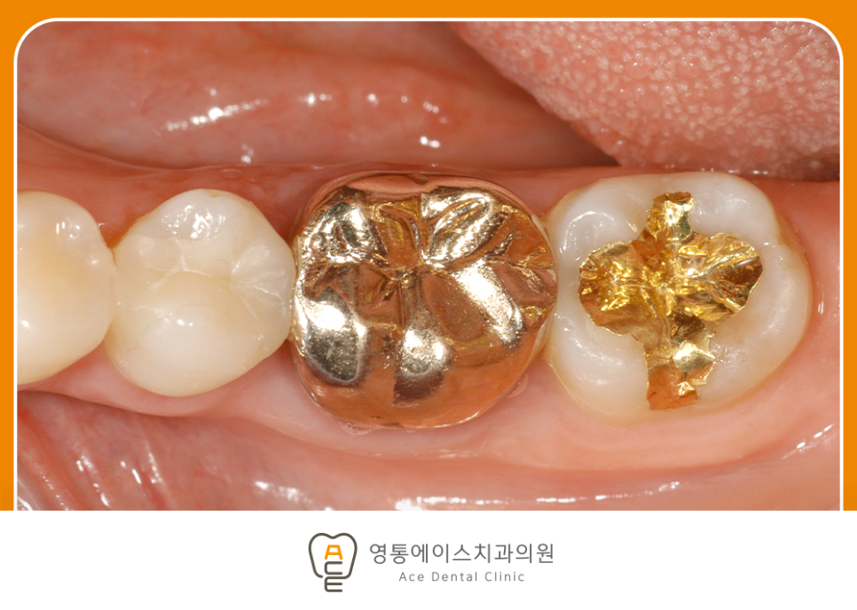 영통에이스치과 충치치료