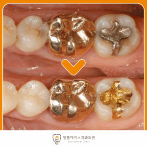 영통에이스치과 충치치료