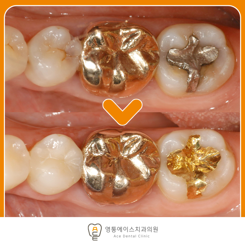 영통에이스치과 충치치료