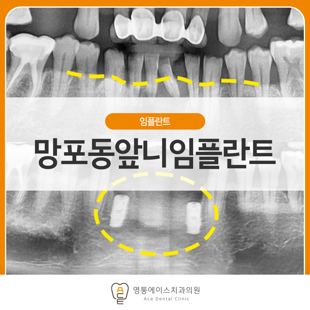 망포동임플란트