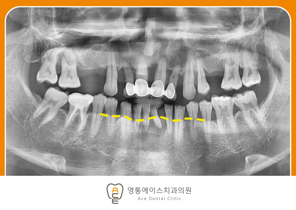 망포동임플란트