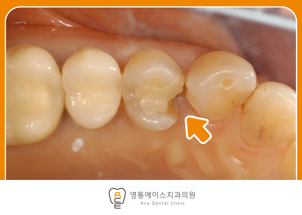 영통에이스치과 레진인레이치료