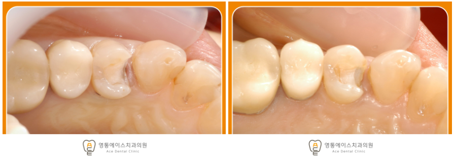 영통에이스치과 레진인레이치료
