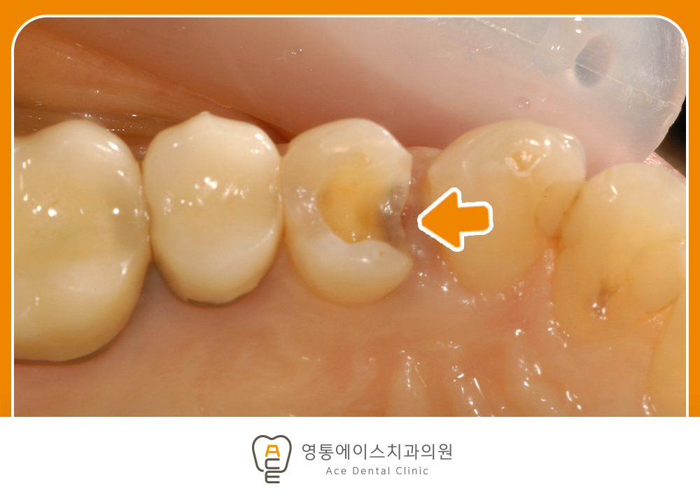 영통에이스치과 레진인레이치료