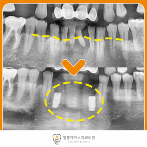 망포동임플란트