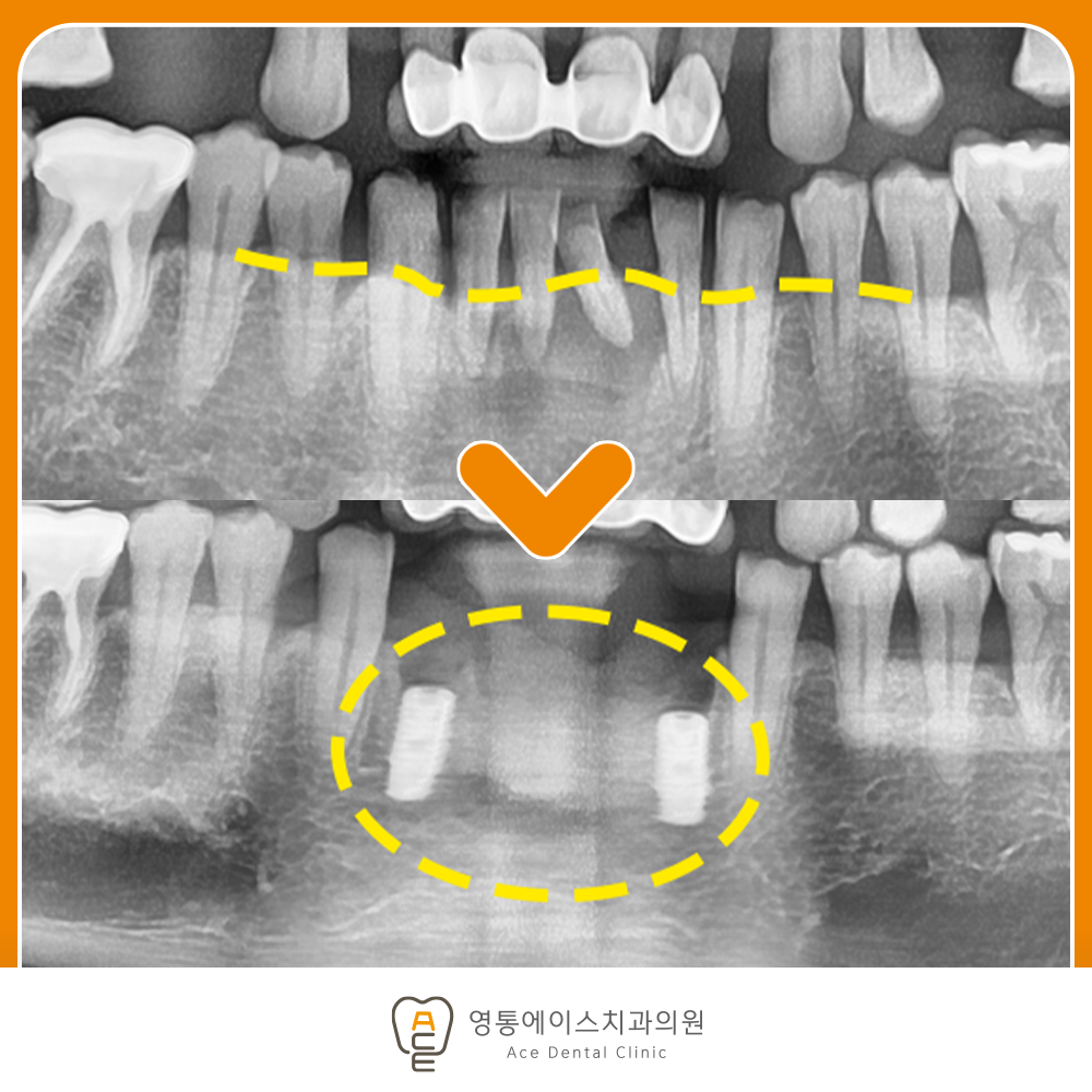 망포동임플란트
