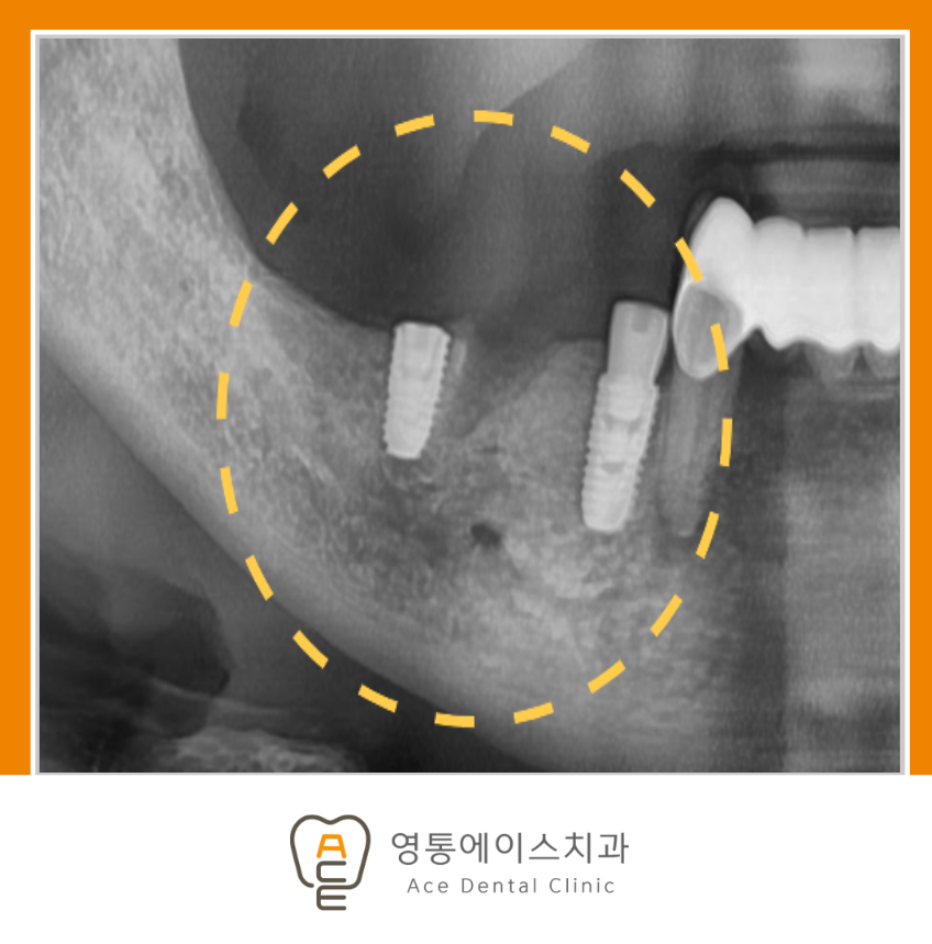 망포역임플란트