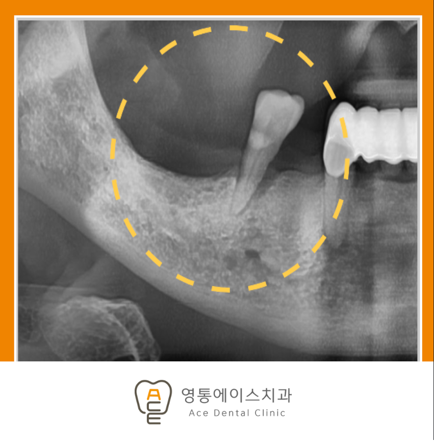 망포역임플란트