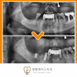 망포역임플란트