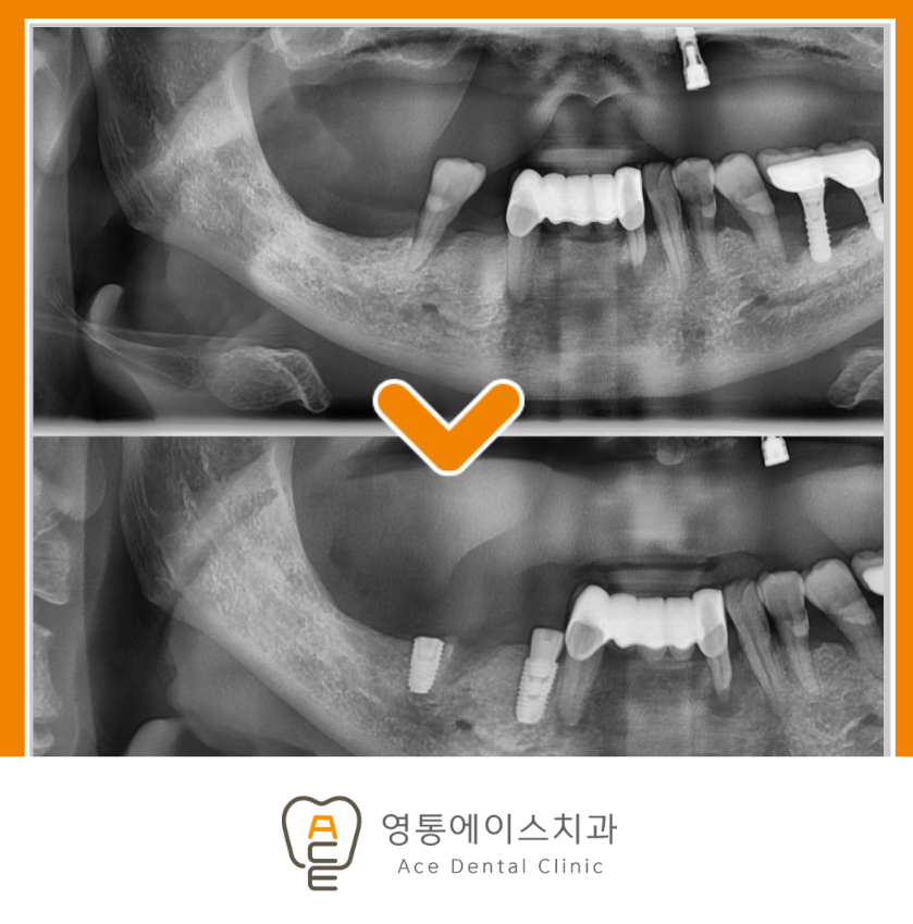 망포역임플란트