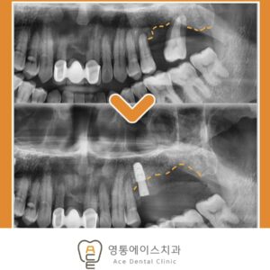 망포동임플란트