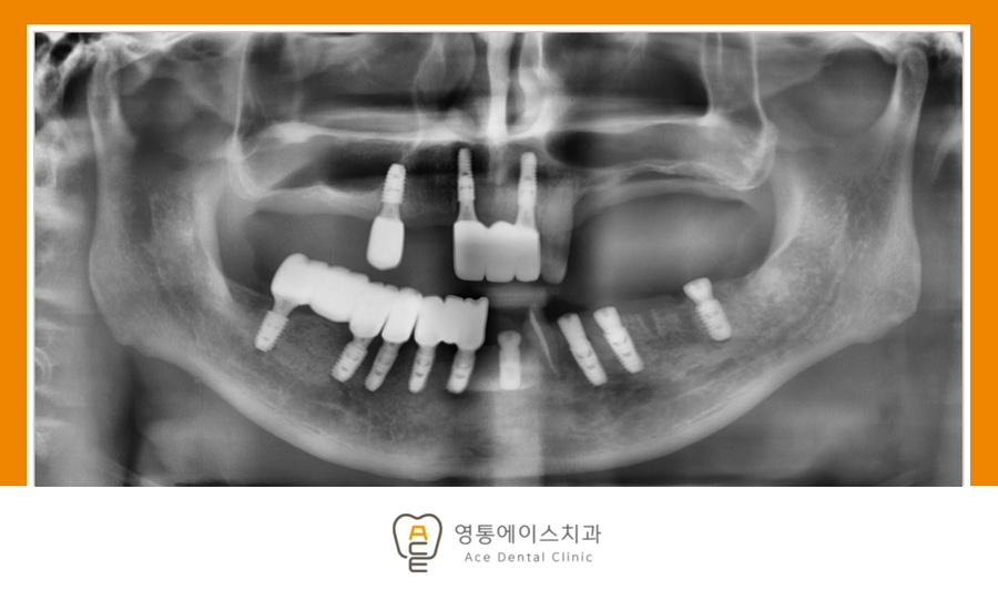 망포역임플란트