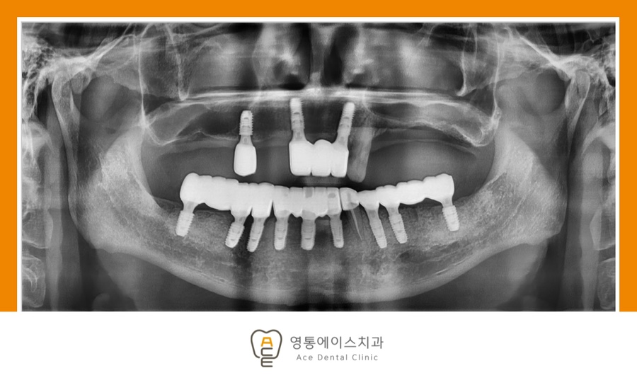 망포역임플란트