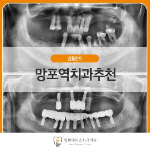 망포역임플란트