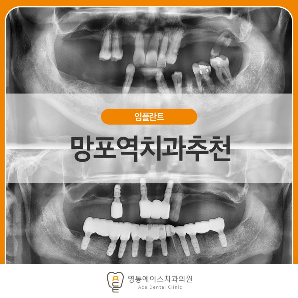 망포역임플란트