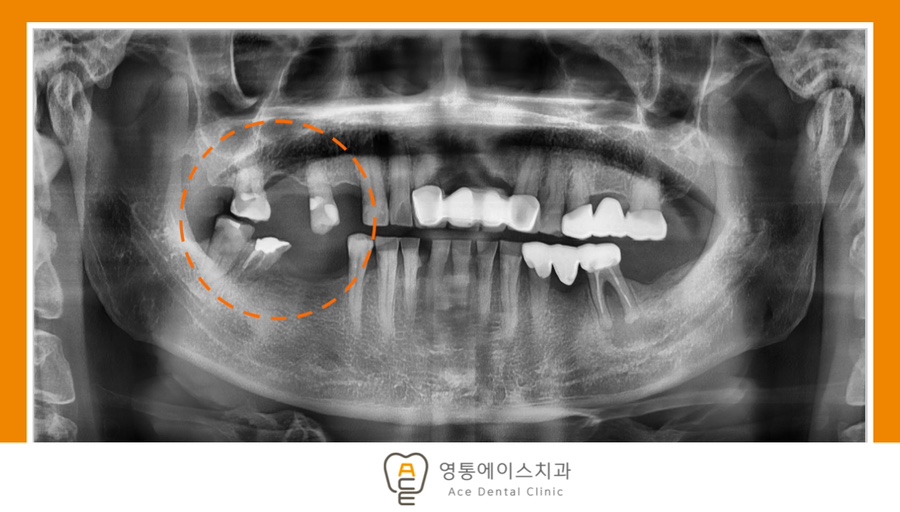 망포동임플란트